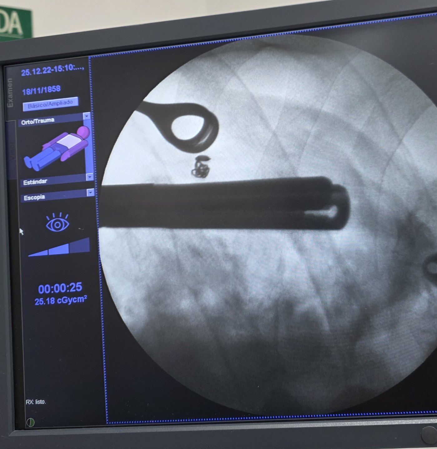 Marcación con coil bajo fluoroscopia para biopsia de nódulo pulmonar pequeño