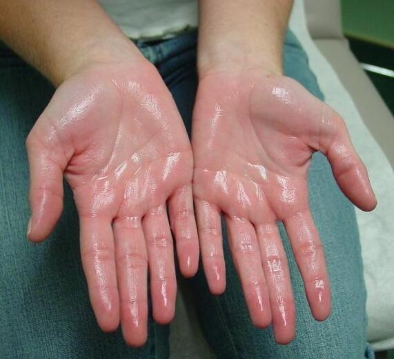 Hiperhidrosis palmar: palmas reales goteando sudor