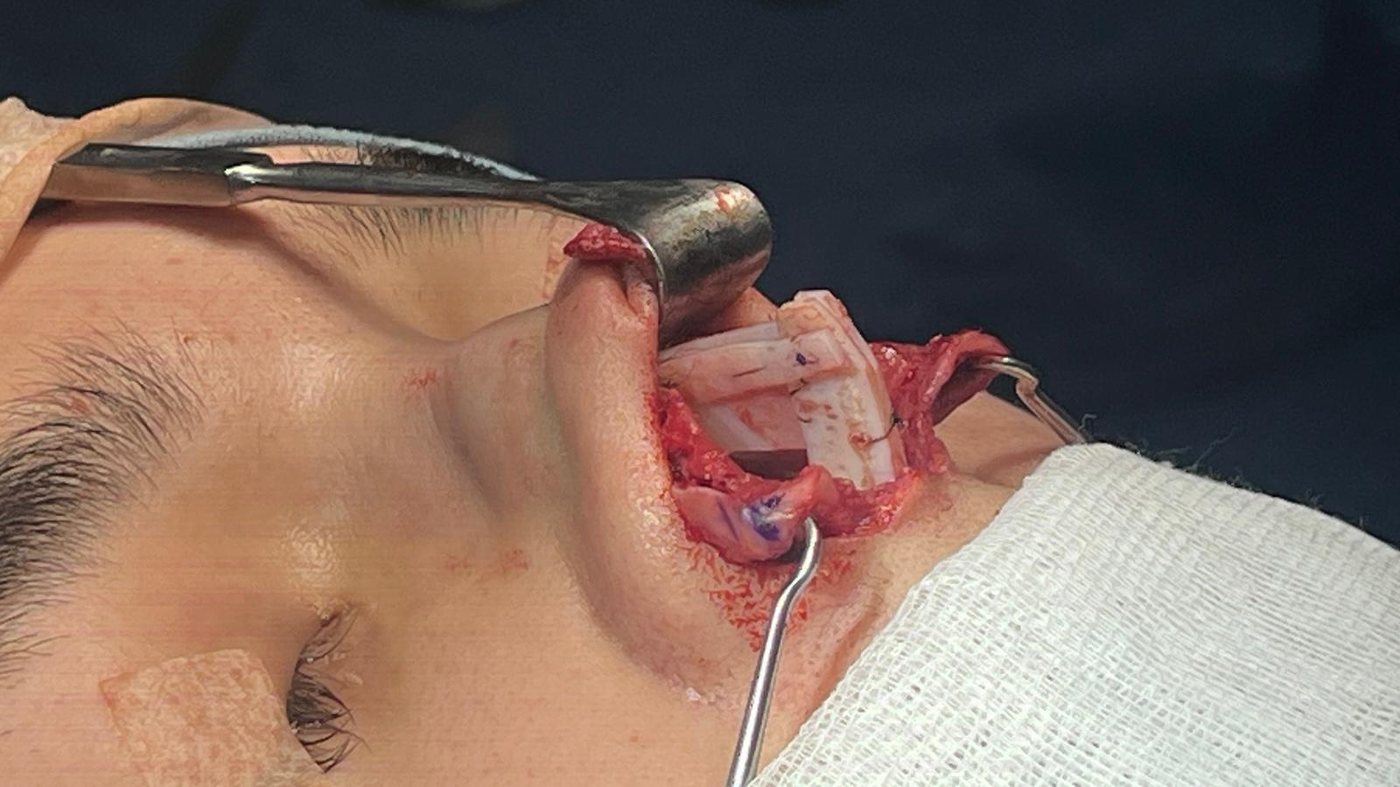 Reconstrucción nasal con injertos de cartílago costal